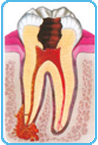 Dente infetto con ascesso