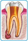 Detersione camera e canali del dente