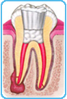 Otturazione canali del dente