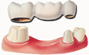 Protesi dentale agganciata a denti esistenti