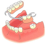 Protesi dentale rimovibile