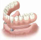 Protesi dentaria agganciata ad impianti in titanio