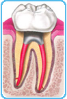 Ripristino protesico del dente