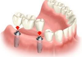 denti fissi su impianti