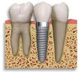 impianti dentali